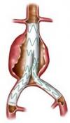 Photo for Endovascular Aneurysm Repair (EVAR) Market | World Players Forecast Analysis Till 2025