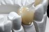 Photo for Global Hybrid-Ceramic Dental CAD/CAM Material Market 2020 | Manufacturers Regions Type And Application Forecast To 2025