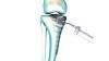 Photo for Bone Graft and Substitutes Market | World Players Forecast Analysis Till 2025