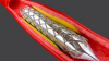 Photo for Coronary Stents Market | World Players Forecast Analysis Till 2025