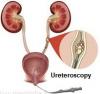 Photo for Ureteroscopy Market | World Players Forecast Analysis Till 2025