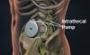 Photo for Intrathecal Pump Market | World Players Forecast Analysis Till 2025