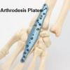 Photo for Arthrodesis Plates Market | World Players Forecast Analysis Till 2025
