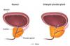 Photo for US Benign Prostatic Hyperplasia (BPH) Procedures Outlook and Opportunities in Grooming Regions