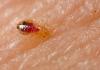 Photo for bed bugs
