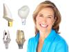 Photo for Dental Implants