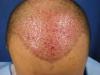Photo for Hair Transplantation in Delhi – Perfect solution to solving the problems of baldness