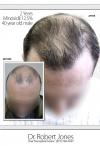 Photo for toronto hair transplant