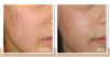 Photo for Global Scar Treatment Market Size, Trends, Growth, Technology, Forecast 2015-2019
