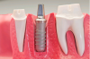 Photo for Cosmetic Dentistry dubai