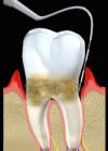 Photo for Restore Your Chipped Teeth with Cosmetic Dentistry