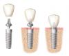 Photo for Restore the Lost Teeth with Dental Implants in Norcross GA